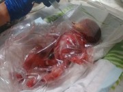 Bà bầu - Kỳ diệu bé sinh non 0,8kg sống sót nhờ… chiếc túi nhựa