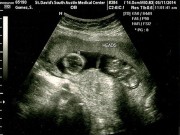 Bà bầu - Bức ảnh siêu âm bụng sau phá thai khiến bà mẹ trẻ "chết lặng"