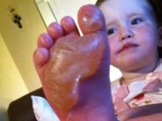 Sức khỏe - Bé gái bỏng chân vì giẫm lên đồ chơi trong ngày nắng nóng