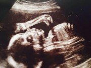Bà bầu - Ngỡ ngàng khi thấy khủng long trong ảnh siêu âm thai