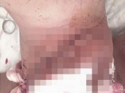 Tin tức - Cứu sống nạn nhân bị chém đứt lìa khí quản