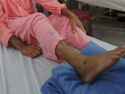 Sức khỏe - Nhiều sai lầm khi xử lý rắn cắn