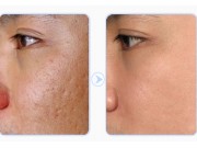 Làm đẹp - Công thức trị sẹo lõm hiệu quả từ nguyên liệu trong bếp