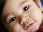 Làm mẹ - Nguyên nhân, biểu hiện và cách phòng chống bệnh thủy đậu ở trẻ em