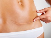 Bà bầu - Vì sao ngày càng nhiều mẹ bầu “chuộng” sinh mổ?