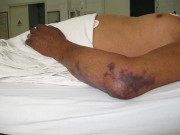 Sức khỏe - Đừng “đùa” với món tiết canh!