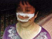 Tin tức - TQ: Chồng cắn đứt mũi vợ vì không trả lời điện thoại