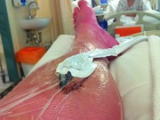 Tin tức - Một phụ nữ bị 'nổ chân' sau khi đi bộ 10km