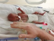 Bà bầu - Hi hữu: Bé sinh non chỉ nặng 0,5 kg sống sót kì diệu