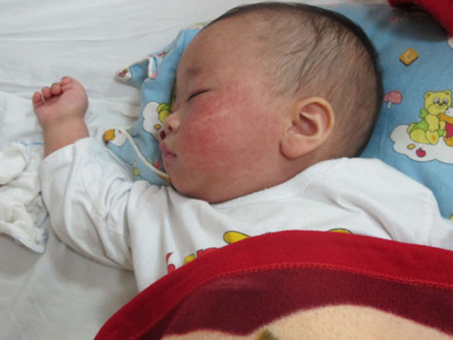 Những điều cần biết về bệnh sởi ở trẻ em