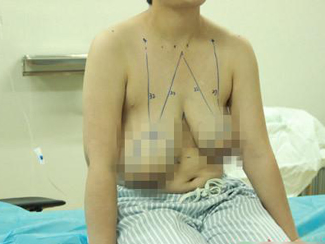 Cho con bú không đúng cách, mẹ “ôm hận” vì ngực bên to bên nhỏ