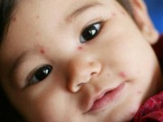 Làm mẹ - 7 thực phẩm trẻ bị thủy đậu cần "tránh xa"