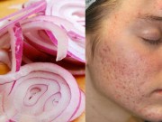 Làm đẹp - Đã tìm ra "thần dược" đánh bay sẹo thâm lâu năm