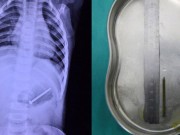 Làm mẹ - Để con cho bà nội trông, mẹ ân hận vì phát hiện dị vật trong bụng con