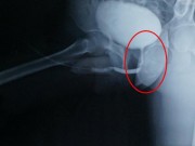 Sức khỏe - Người đàn ông xuất tinh qua đường... hậu môn