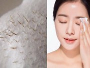 Làm đẹp - Không cần nặn, mụn đầu đen sẽ tự chui ra chỉ với 1 quả chanh