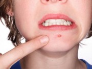Làm đẹp - Tránh xa những sai lầm "gây chết người" khi nặn mụn