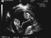 Bà bầu - Những bà mẹ đang mang bầu vẫn tiếp tục thụ thai khiến bác sĩ kinh ngạc