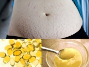 Đã tìm ra cách thổi bay các vết rạn da xấu xí cho chị em sau sinh