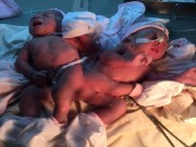 Tin tức - Xót thương hai bé gái song sinh dính liền mông, không có hậu môn