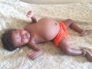 Bà bầu - Bé gái 1 tuổi mang bầu bào thai ký sinh 3,5kg khiến cha mẹ hoảng loạn