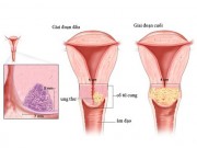 Sức khỏe - Chuyên gia đầu ngành chia sẻ 4 bước phát hiện sớm ung thư cổ tử cung