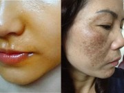Làm đẹp - Thổi bay nám - tàn nhang nhờ tinh dầu gấc tự chế tại nhà