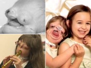 Bà bầu - Bác sĩ nói không sống quá 1 đêm, 13 năm sau "em bé không mặt" khiến ai cũng ngỡ ngàng
