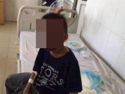 Tin tức - Ngã vào bếp, cậu bé 14 tuổi cháy mặt có nguy cơ hỏng 2 mắt