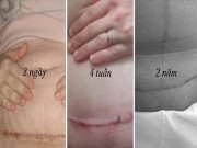 Bà bầu - Đây là hình ảnh chân thực về sự thay đổi của vết sẹo sinh mổ từ 1 ngày đến 2 năm