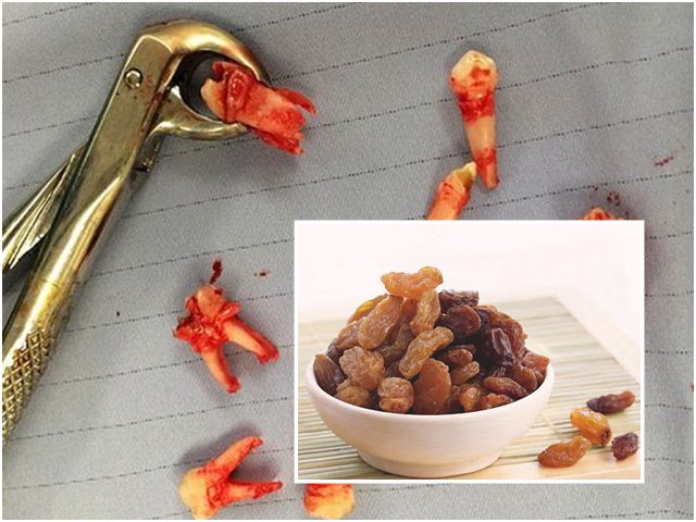 Ăn nhiều nho khô, trẻ vô tình bị hỏng hàm răng xinh