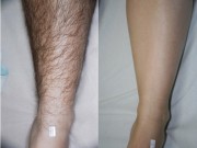 Làm đẹp - Bất ngờ vì công dụng triệt lông không đau không rát của nước chanh