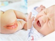Làm mẹ - 9 mẹo lành tính giúp trị hăm tã ở trẻ cực nhanh