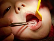 Làm mẹ - Dị vật trong tai, mũi, họng trẻ - cha mẹ cần chú ý để tránh ân hận suốt đời