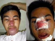 Làm đẹp - Nâng mũi với giá 250 ngàn đồng, chàng trai phải chịu biến chứng kinh hoàng