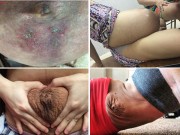 Bà bầu - Xót xa hình ảnh những chiếc bụng bầu rạn da đến rỉ máu