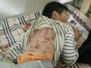 Tin tức - Cậu bé 10 tuổi bị cha dượng đánh đập nhiều lần thâm tím người