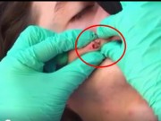 Clip Eva - Video nặn mụn này đã thu hút 12 triệu lượt xem chỉ sau vài ngày