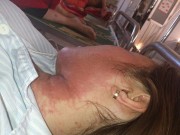 Làm đẹp - Nổi mụn, rỉ nước vàng khắp đầu vì thuốc nhuộm tóc