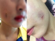 Làm đẹp - Bị lõm, thủng mặt do phẫu thuật tạo má lúm đồng tiền