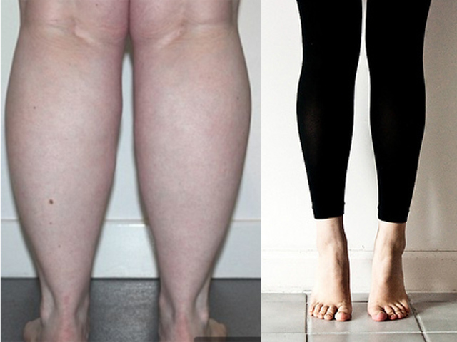 Bắp chân to đến mấy cũng thon gọn nếu áp dụng 4 bước sau