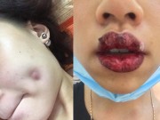 Làm đẹp - Rủi ro không ngờ tới từ 3 kiểu thẩm mỹ hot nhất hiện nay