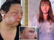 Tin tức - Kinh hãi những khuôn mặt phồng rộp, biến dạng vì thuốc nhuộm tóc