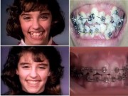 Đẹp - Clip niềng răng thu hút 10 triệu lượt xem một ngày sẽ khiến bạn sửng sốt
