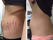 Làm đẹp - Rạn da đến đâu cũng sẽ mờ dần rồi mất hẳn với 7 cách này