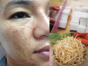 Làm đẹp - Trị nám và tàn nhang đáng ghét nhờ 2 thực phẩm có sẵn trong bếp
