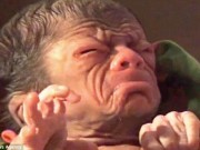 Tin tức - Mắc bệnh lạ, bé trai vừa chào đời đã mang khuôn mặt như ông lão 80