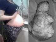 Bà bầu - Mang thai nhiều tháng không đẻ, mẹ ngỡ ngàng khi thấy dị vật trong bụng