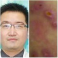 Tin tức - Kinh hãi 20 con giòi làm tổ dưới da người đàn ông