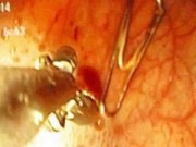 Tin tức - Trẻ 13 tháng tuổi nuốt kẹp giấy